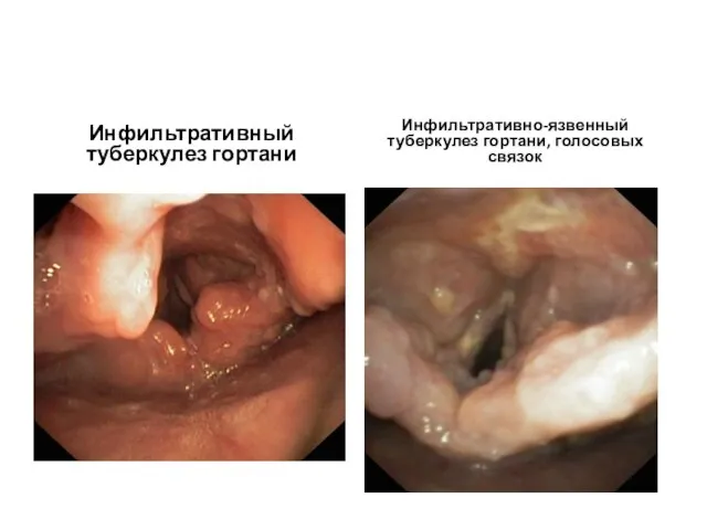 Инфильтративный туберкулез гортани Инфильтративно-язвенный туберкулез гортани, голосовых связок