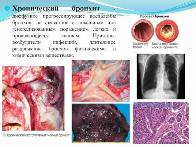 Хронический бронхит - диффузное прогрессирующее воспаление бронхов, не связанное с локальным