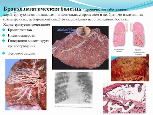 Бронхоэктатическая болезнь - хроническое заболевание, характеризующееся локальным нагноительным процессом в необратимо