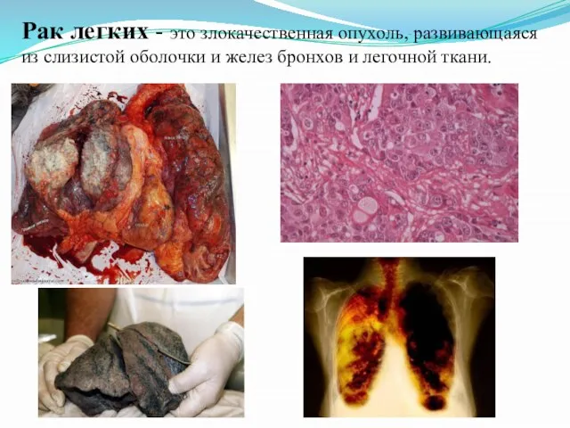 Рак легких - это злокачественная опухоль, развивающаяся из слизистой оболочки и желез бронхов и легочной ткани.