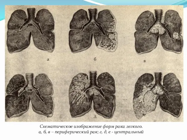 Схематическое изображение форм рака легкого. а, б, в – периферический рак;