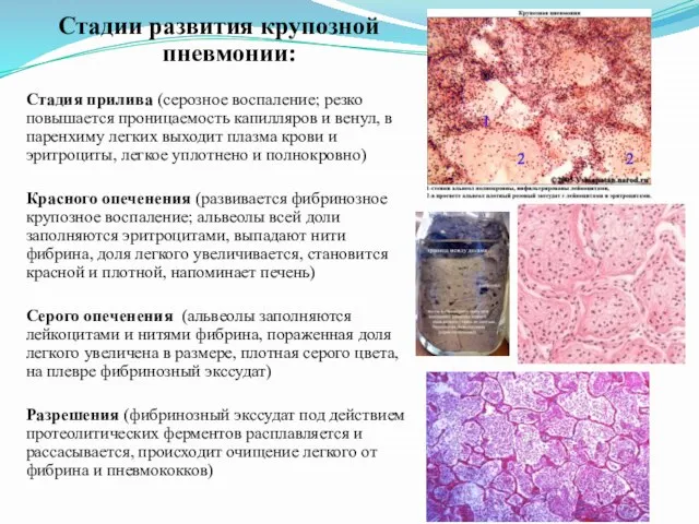 Стадии развития крупозной пневмонии: Стадия прилива (серозное воспаление; резко повышается проницаемость