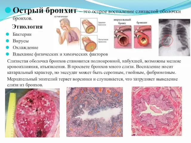 Острый бронхит – это острое воспаление слизистой оболочки бронхов. Этиология Бактерии