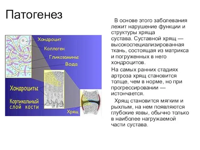 Патогенез В основе этого заболевания лежит нарушение функции и структуры хряща