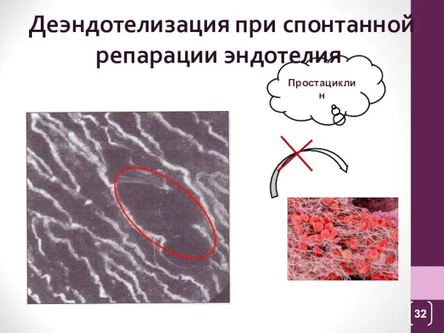 Простациклин Деэндотелизация при спонтанной репарации эндотелия