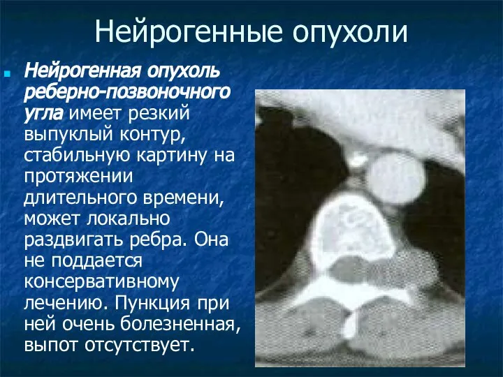 Нейрогенные опухоли Нейрогенная опухоль реберно-позвоночного угла имеет резкий выпуклый контур, стабильную