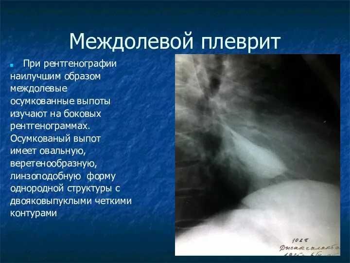 Междолевой плеврит При рентгенографии наилучшим образом междолевые осумкованные выпоты изучают на