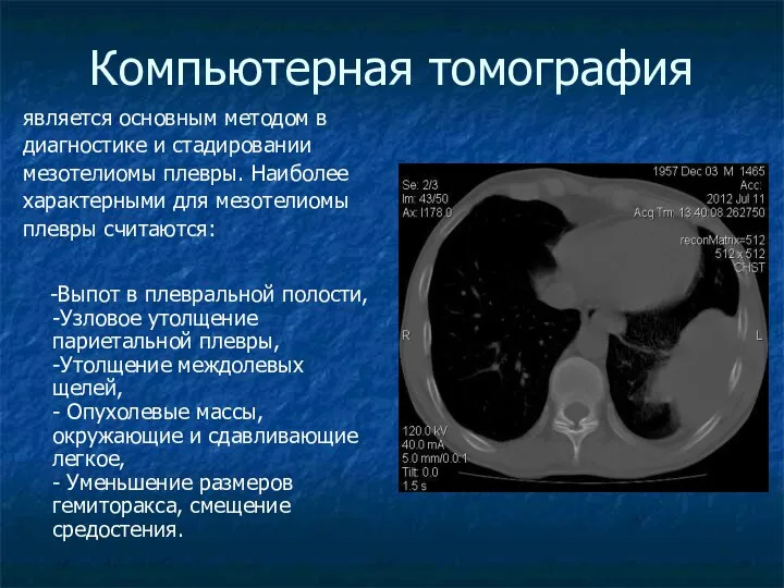 Компьютерная томография является основным методом в диагностике и стадировании мезотелиомы плевры.