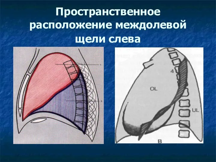 Пространственное расположение междолевой щели слева