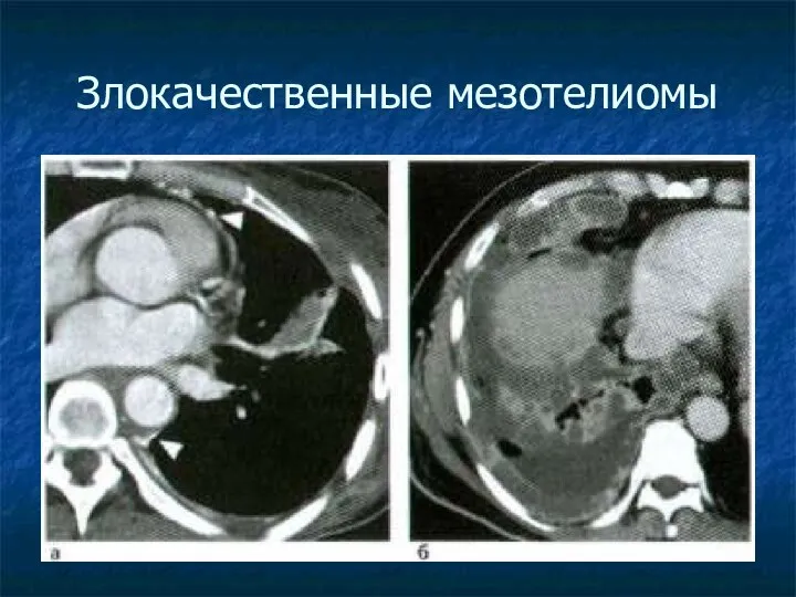 Злокачественные мезотелиомы