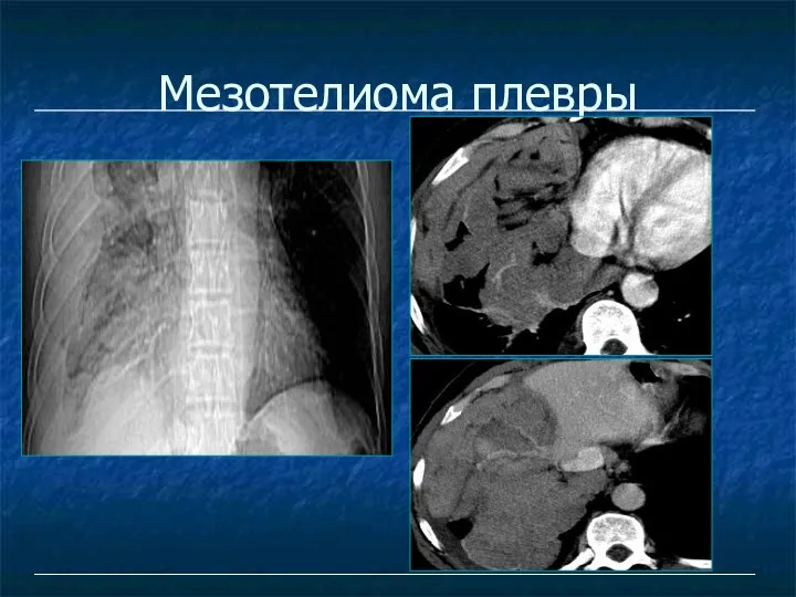 Мезотелиома плевры