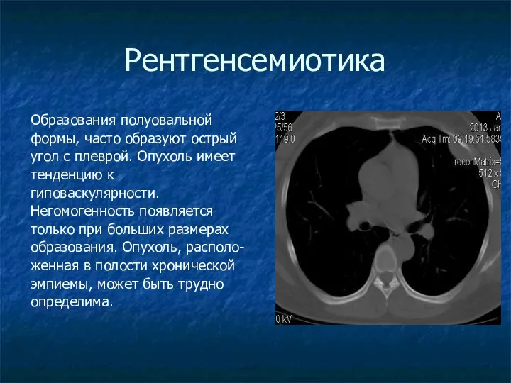 Рентгенсемиотика Образования полуовальной формы, часто образуют острый угол с плеврой. Опухоль