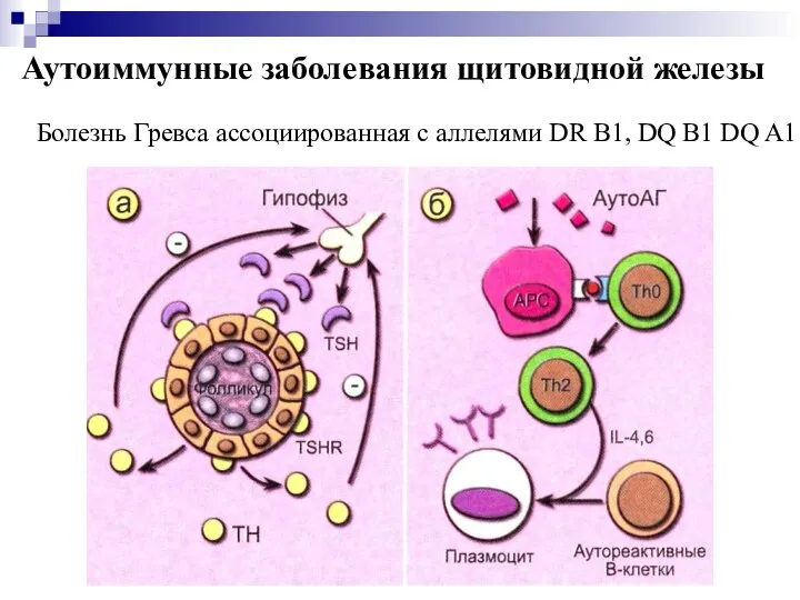 Аутоиммунные заболевания щитовидной железы Болезнь Гревса ассоциированная с аллелями DR B1, DQ B1 DQ A1