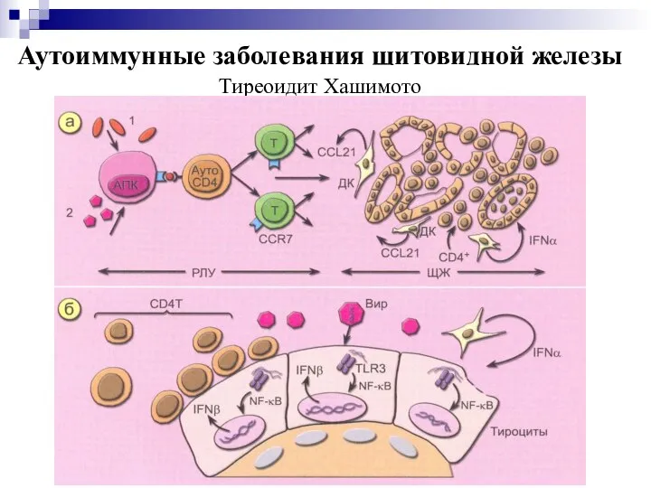 Аутоиммунные заболевания щитовидной железы Тиреоидит Хашимото