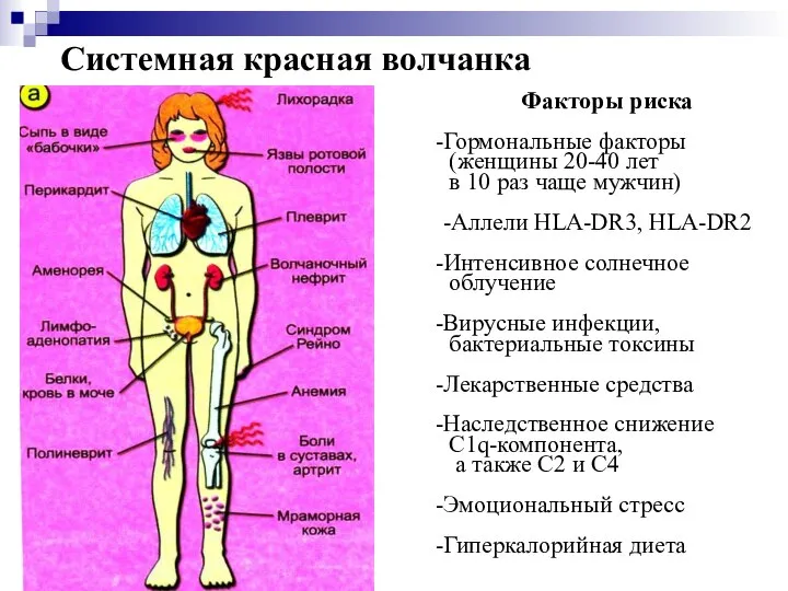 Системная красная волчанка Факторы риска Гормональные факторы (женщины 20-40 лет в