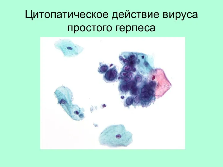 Цитопатическое действие вируса простого герпеса
