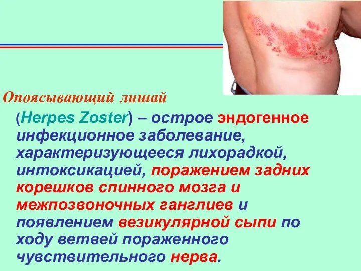 Опоясывающий лишай (Herpes Zoster) – острое эндогенное инфекционное заболевание, характеризующееся лихорадкой,