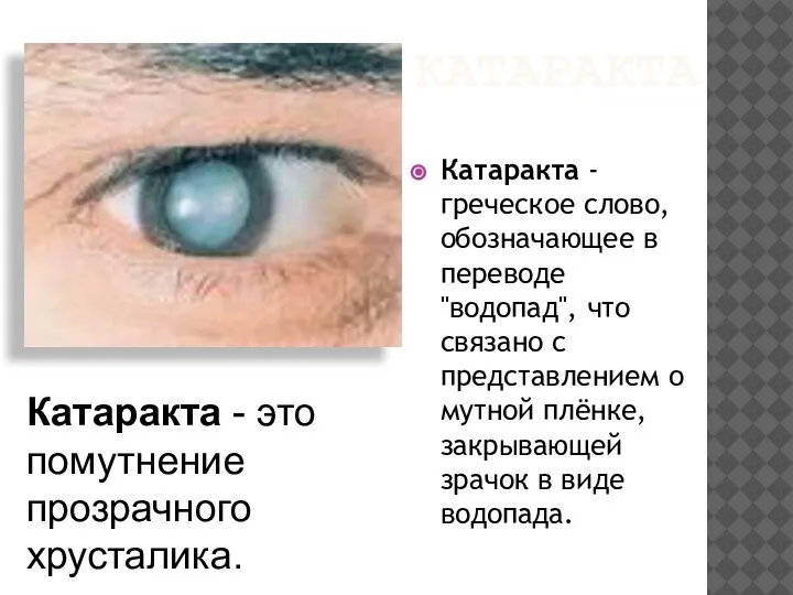 КАТАРАКТА Катаракта - греческое слово, обозначающее в переводе "водопад", что связано