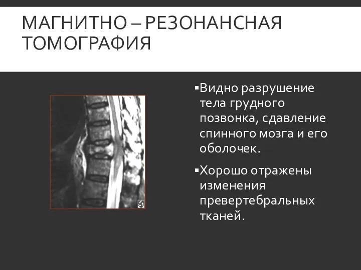 МАГНИТНО – РЕЗОНАНСНАЯ ТОМОГРАФИЯ Видно разрушение тела грудного позвонка, сдавление спинного