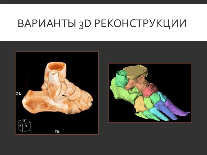 ВАРИАНТЫ 3D РЕКОНСТРУКЦИИ