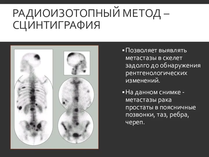 РАДИОИЗОТОПНЫЙ МЕТОД – СЦИНТИГРАФИЯ Позволяет выявлять метастазы в скелет задолго до