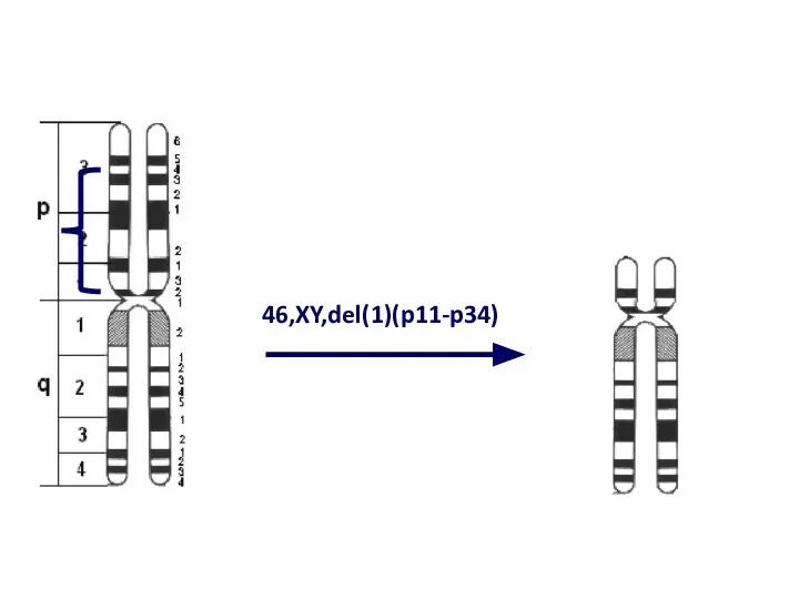 46,XY,del(1)(p11-p34)‏