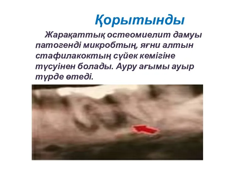 Қорытынды Жарақаттық остеомиелит дамуы патогенді микробтың, яғни алтын стафилакоктың сүйек кемігіне