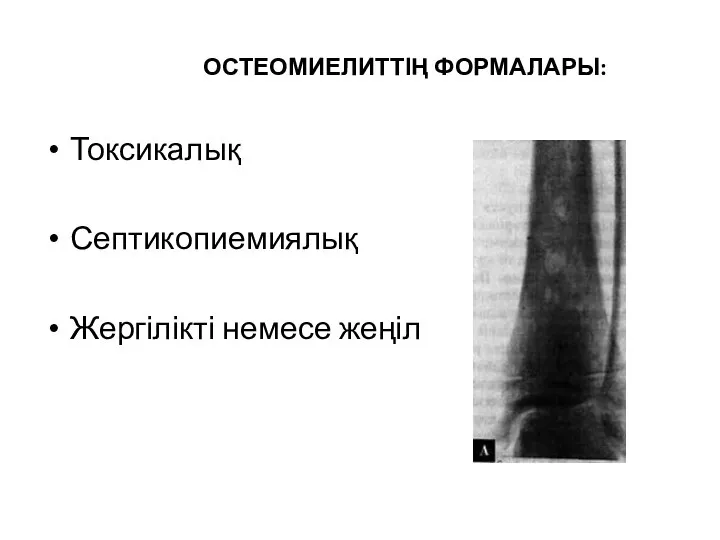 ОСТЕОМИЕЛИТТІҢ ФОРМАЛАРЫ: Токсикалық Септикопиемиялық Жергілікті немесе жеңіл