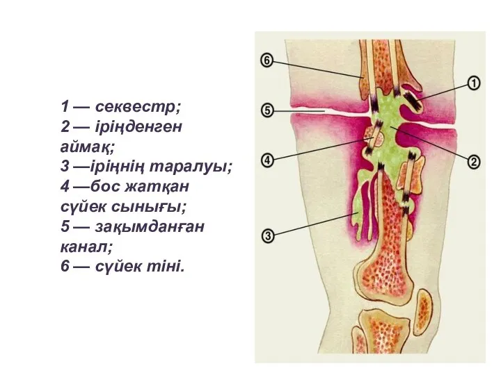 1 — секвестр; 2 — іріңденген аймақ; 3 —іріңнің таралуы; 4