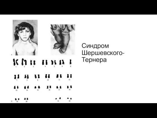 Синдром Шершевского-Тернера