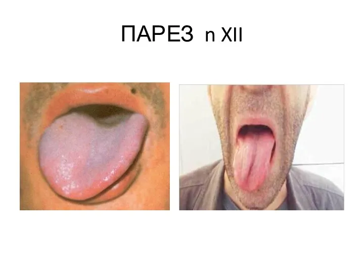 ПАРЕЗ n XII