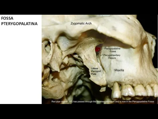 FOSSA PTERYGOPALATINA