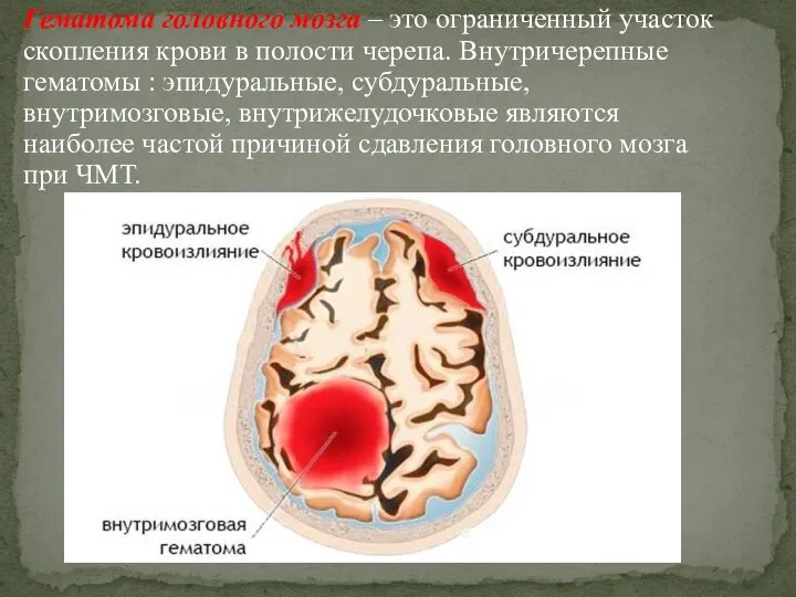 Гематома головного мозга – это ограниченный участок скопления крови в полости