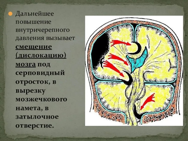 Дальнейшее повышение внутричерепного давления вызывает смещение (дислокацию) мозга под серповидный отросток,