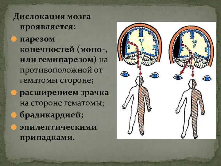 Дислокация мозга проявляется: парезом конечностей (моно-, или гемипарезом) на противоположной от