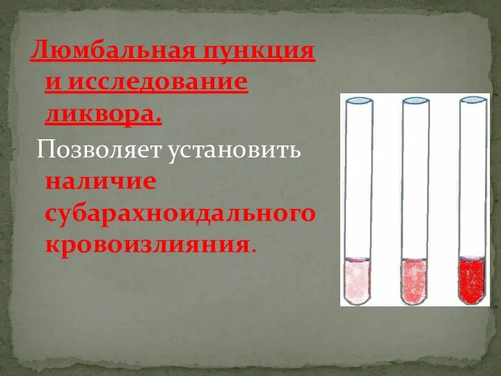 Люмбальная пункция и исследование ликвора. Позволяет установить наличие субарахноидального кровоизлияния.