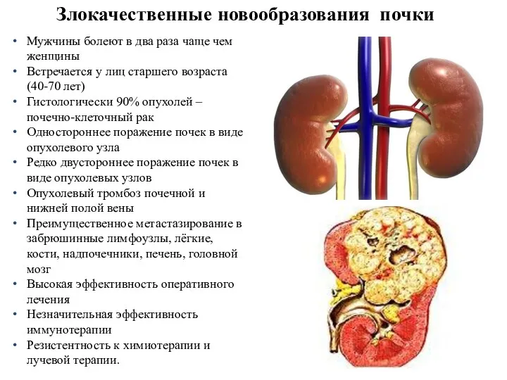 Злокачественные новообразования почки Мужчины болеют в два раза чаще чем женщины