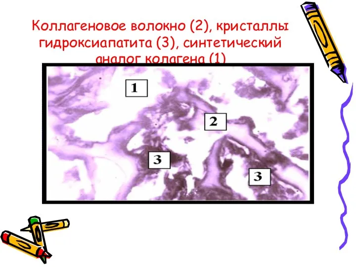 Коллагеновое волокно (2), кристаллы гидроксиапатита (3), синтетический аналог колагена (1)