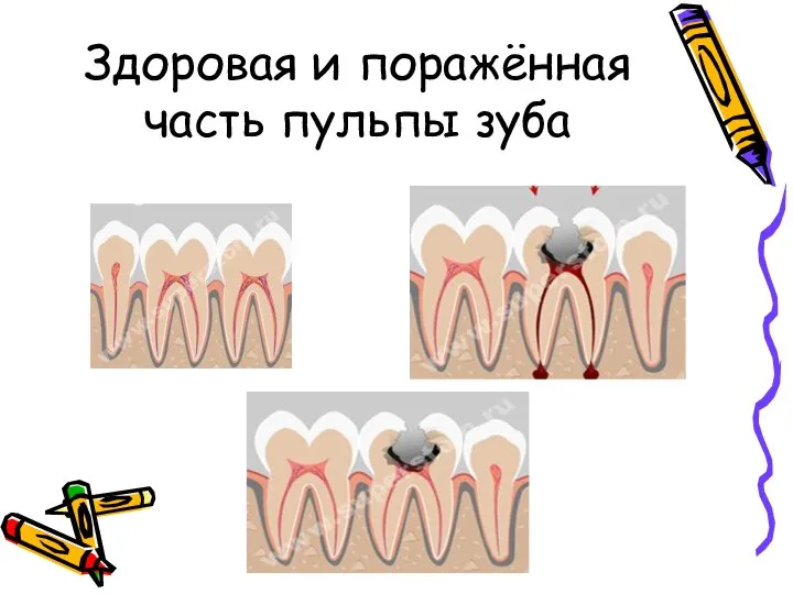 Здоровая и поражённая часть пульпы зуба