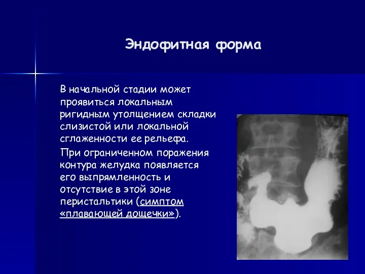 Эндофитная форма В начальной стадии может проявиться локальным ригидным утолщением складки