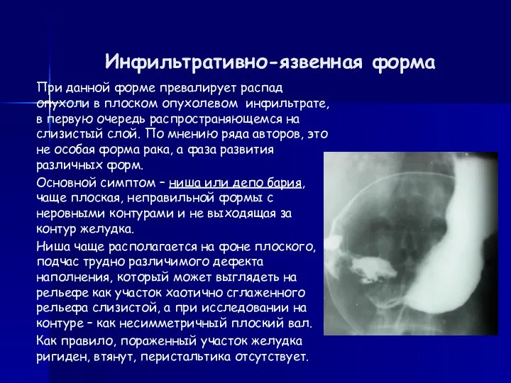 Инфильтративно-язвенная форма При данной форме превалирует распад опухоли в плоском опухолевом