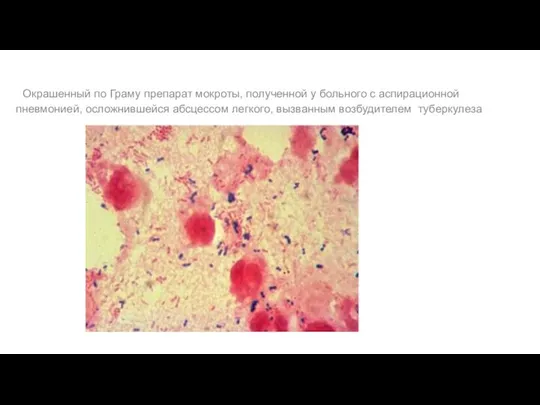 Окрашенный по Граму препарат мокроты, полученной у больного с аспирационной пневмонией,