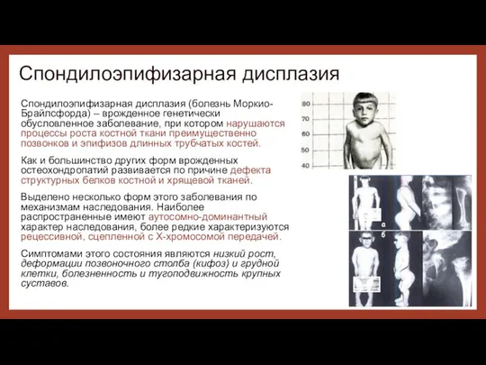 Спондилоэпифизарная дисплазия (болезнь Моркио-Брайлсфорда) – врожденное генетически обусловленное заболевание, при котором