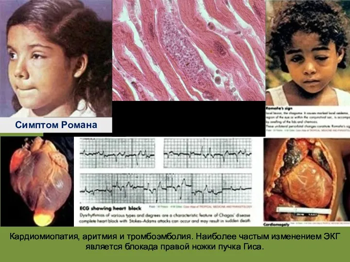 Кардиомиопатия, аритмия и тромбоэмболия. Наиболее частым изменением ЭКГ является блокада правой ножки пучка Гиса. Симптом Романа