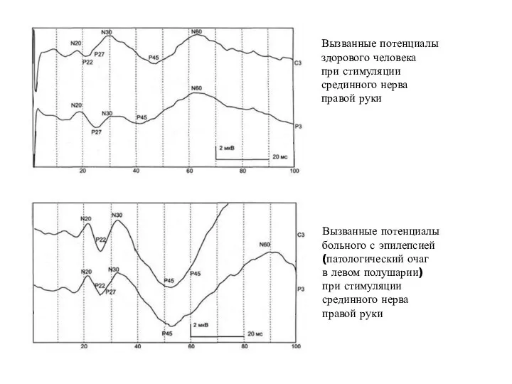 Вызванные потенциалы здорового человека при стимуляции срединного нерва правой руки Вызванные