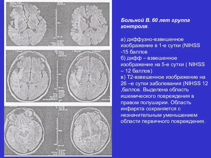 Больной В. 60 лет группа контроля. а) диффузно-взвешенное изображение в 1-е