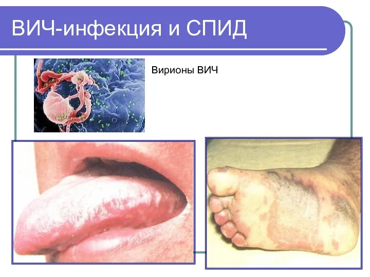 ВИЧ-инфекция и СПИД Вирионы ВИЧ