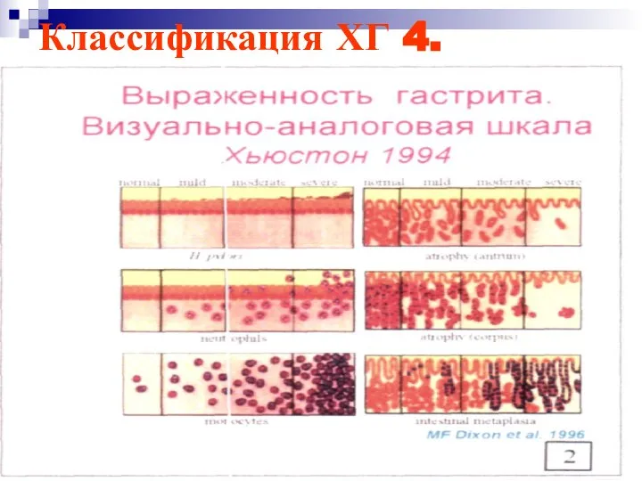 Классификация ХГ 4.