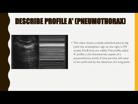 DESCRIBE PROFILE A' (PNEUMOTHORAX) This video shows a totally abolished pleural