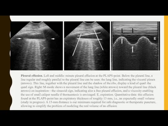 Pleural effusion. Left and middle: minute pleural effusion at the PLAPS-point.